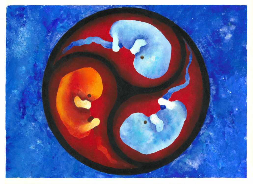 Drillinge im Mutterleib, aber nur ein Kind wird geboren. Der Alleingeborene Zwilling hat seine 2 Geschwister vor der Geburt durch ein frühes Trauma verloren.